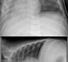 Bilateralni pneumonija: kako se manifestuje, gdje i kako ga liječiti