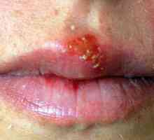 Da li postoji lijek za herpes na usni koja može riješi ove bolesti zauvijek?