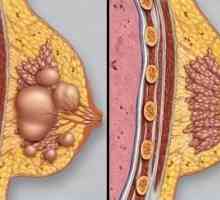 Dojke fibroze: dijagnostici i liječenju