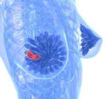 Fibrocističnih bolesti dojke: liječenje, simptomi i uzroci