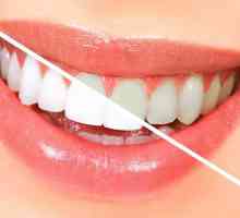 Fluorisanje zuba - što je to? Kako je postupak duboke fluorisanje zube?