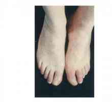 Gangrena nogu: uzroci, simptomi i tretman