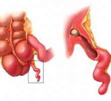 Gangrenu apendicitis: uzroci, simptomi, dijagnoza