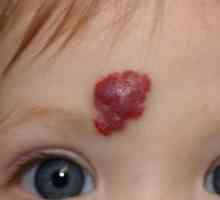 Hemangioma lica: Uzroci i liječenje. Hemangioma na licu odraslih i djece