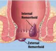 Hemoroidi nakon porođaja: tretman dojenja. Šta alati mogu se koristiti?