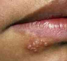 Herpes na usnama: kako da se širi? Cure za herpes na usni. Da li herpes je opasno?