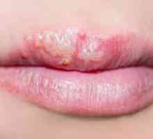 Herpes na usnama: kako izliječiti sve narodne lekove? Da li je moguće izliječiti hladno rane na…