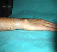 Higroma zglob: liječenje bez operacije folk pravni lijekovi (recenzija)