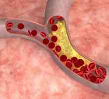 Hiperkolesterolemija - to ... podignuta holesterola. porodične hiperholesterolemia