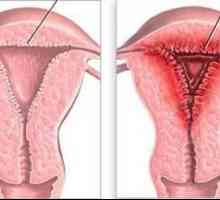 Endometrija hiperplazija: šta je to? Uzroci, Simptomi i metode tretiranja
