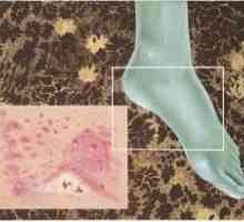 Gljivice na nogama: simptomi, liječenje