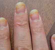 Gljivice na noktima ruku: opis bolesti i liječenja