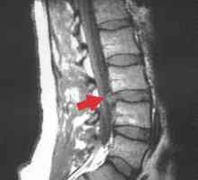 Spinalni disk hernija