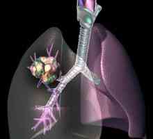 Hemoterapije za rak pluća. Kako tretirati rak pluća