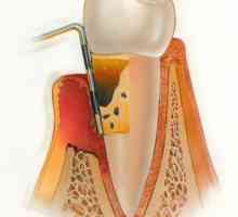 Hronične i akutne parodontitis: simptomi, uzroci i liječenje