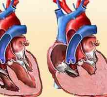 CHF: klasifikacije. Simptomi liječenje hroničnog zatajenja srca