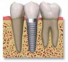 Dentalni implantati: recenzije operacije pacijent
