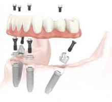 Dentalnih implantata: kontraindikacije, pravi štetu