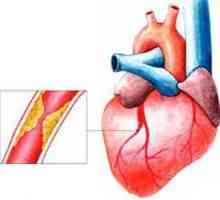 Srčani udar - jedan od najčešćih ljudskih bolesti
