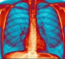 Udisanje bronhitis: ne samo moguće, ali je potrebno!