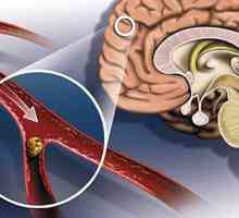 Moždani udar: simptomi i posljedice. Glavni simptomi moždanog udara i microstroke