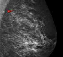 Intramamarnih limfnih čvorova dojke: šta je, opis, uzroci i karakteristike tretman