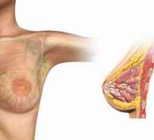 Invazivni karcinom dojke: uzroci, dijagnoza, liječenje. Krvi za tumor markere