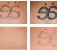 Osloboditi se greške iz prošlosti: Laser Uklanjanje tetovaža