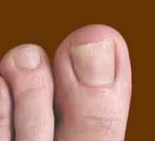 Efikasan tretman gljivičnih nokte narodne lekove