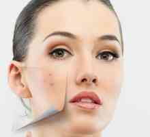 Djelotvoran pravni lijek za akne na licu. Kako prevazići bubuljice na licu