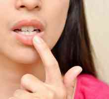 Eksfolijativna inflamacija usana: uzroci, liječenje, fotografije