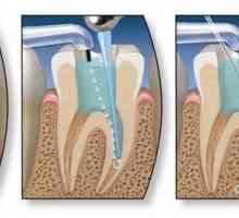 Endodontska terapija zuba. faza endodontskog