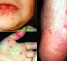 Enterovirus infekcije kod djeteta: liječenje, simptomi, prevencija