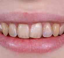 Dental Erozija: opis, uzroci, simptomi i karakteristike tretman