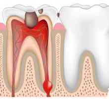 Faze pulpitis liječenja medikamentima. endodontskog liječenja