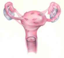 Kako tretirati endometrioze? endometrioze: što je to i kako da se zaštite od ove bolesti
