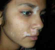 Kako tretirati vitiligo, da se poveća šanse za oporavak