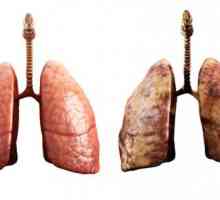 Kako pravilno liječenje upale pluća