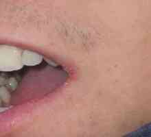 Kako tretirati perleches usne u uglovima popularne načine i koriste droge