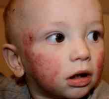 Kako se kožne bolesti u djece