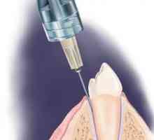 Kako ultrakain u stomatologiji?