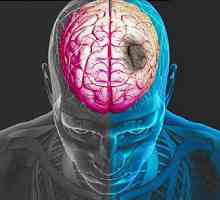Kako prepoznati moždani udar blagovremeno?