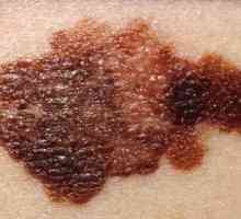 Kako prepoznati melanom u ranoj fazi? Znaci i simptomi melanoma kože (foto)