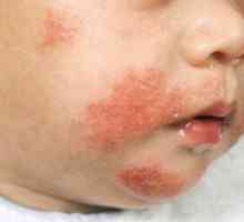 Ono što bi trebalo da bude lijek za djecu od alergija
