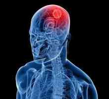 Ono što je simptom raka mozga je prvi poziv za buđenje?