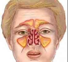 Koji su simptomi upale sinusa? liječenje bolesti