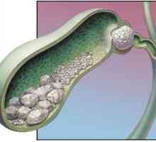 Kamenje u žučne kanale: uzroci, simptomi i tretman