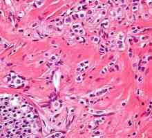 Karcinom - Što je to? planocelularni karcinom