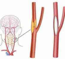 Karotidne endarterektomija: indikacije, postoperativne komplikacije, radi mišljenja, prednosti i…