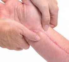 Keloidi i hipertrofične ožiljke: opis, vrste, uzroci i liječenje